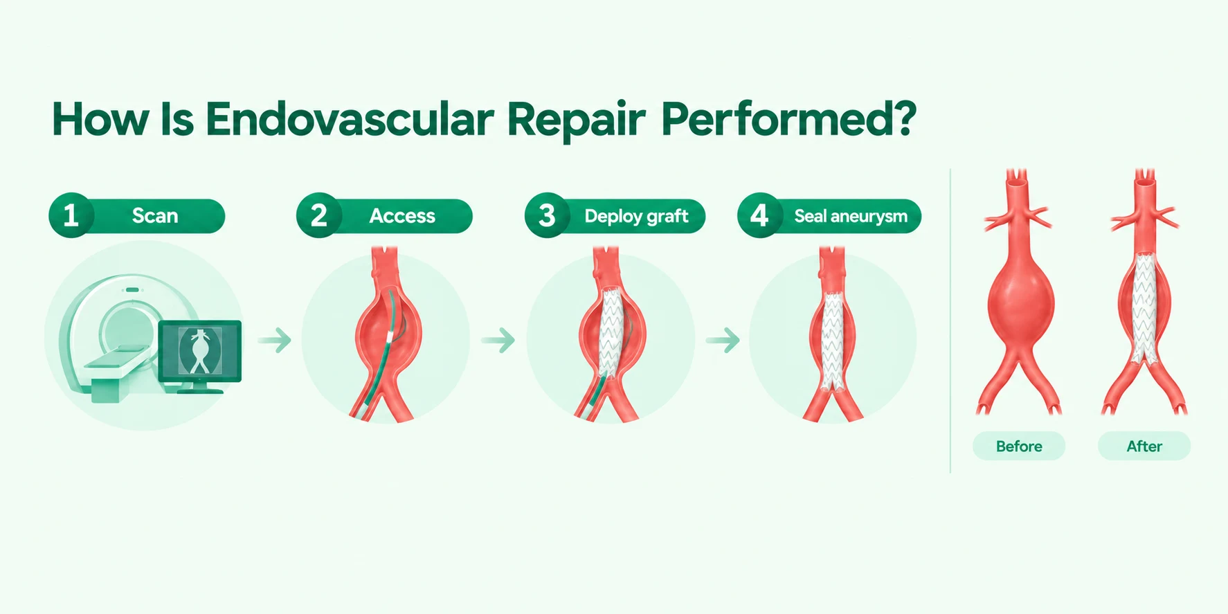 Four-step infographic showing how an endovascular stent graft repairs an aortic aneurysm.